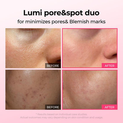 Verfeinert Poren & mildert Pickelmale