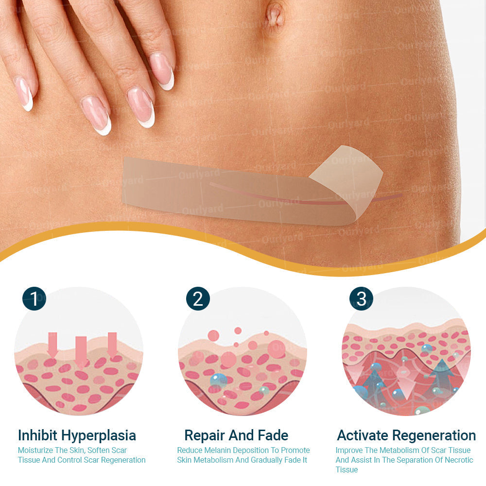Ourlyard® Hyaluron-Nano-Mikronadel-Tape: Intensive Narbenpflege & Hautregeneration